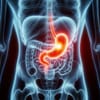 Gastric Cancer